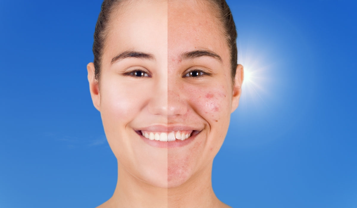 Do Sunbeds Help with Acne?